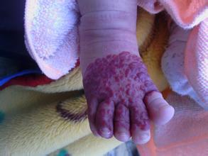 诱发血管瘤的原因 疾病的发生给患者造成危害