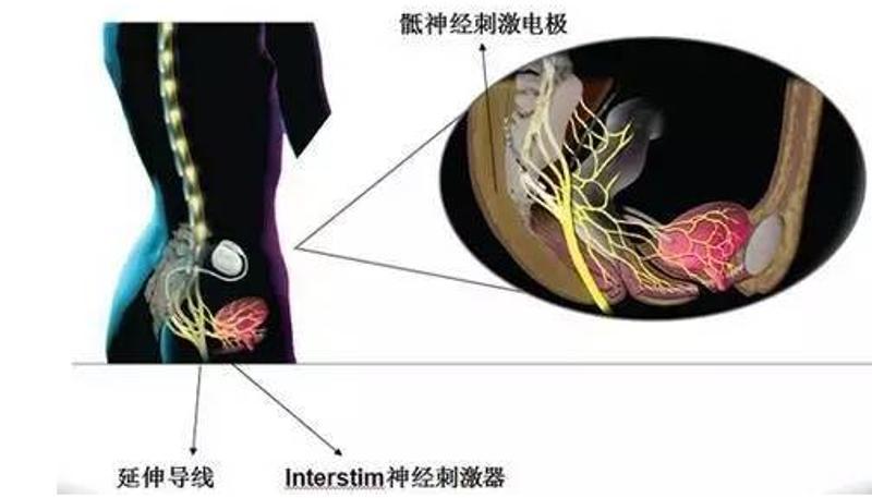 膀胱起搏器可"私人定制"