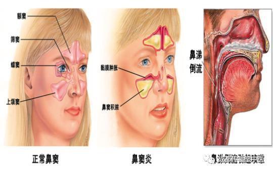 上颌窦位置脸颊里侧,额窦则在两眉毛后上方,筛窦沿着鼻根中线两侧往深