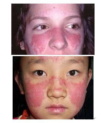 系统性红斑狼疮的护肤指南你了解吗