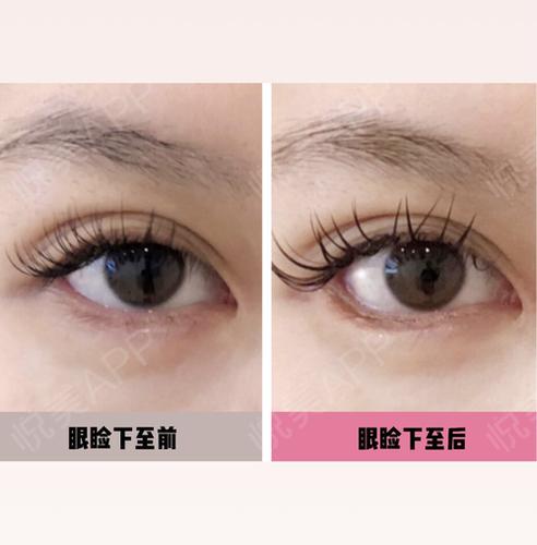 变美小心机眼睑下至术