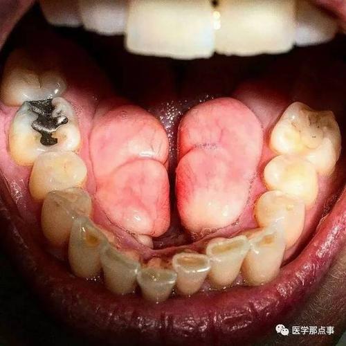 图中这种实际上叫"下颌隆突或译下颌圆枕",本质是一种外生骨疣,是骨