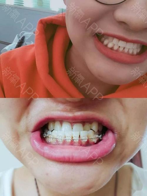 下牙套啦,不再是地包天了