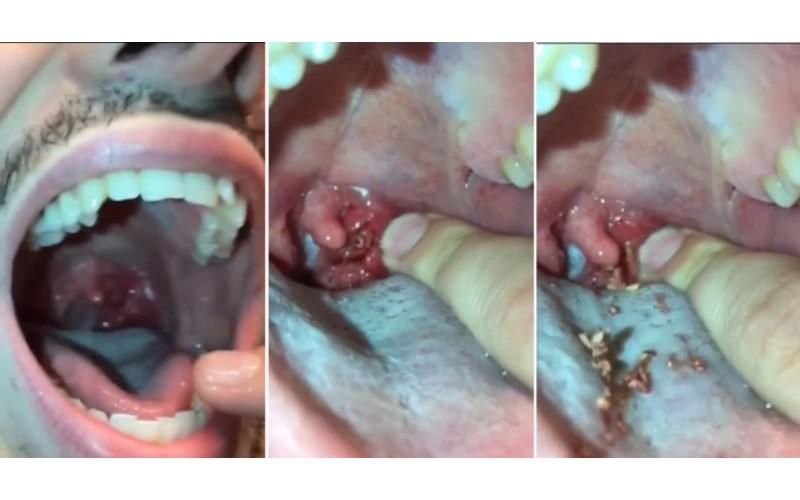 慎入 男自挤口腔内的「扁桃腺结石」下一秒.