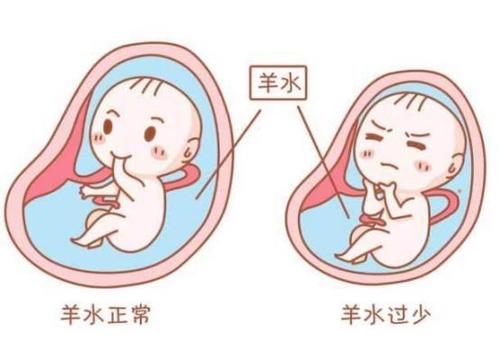 孕妈"尿液"有这2个变化,暗示子宫内"羊水不足",别马虎