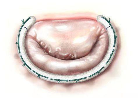 浙江省人民医院通过腋下心脏微创二尖瓣修复手术