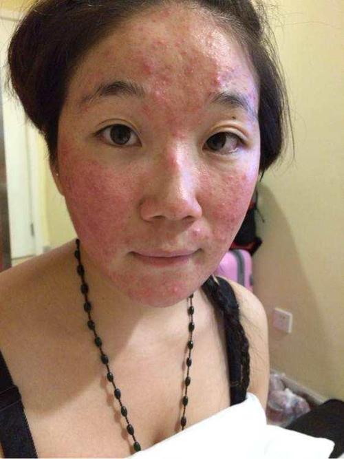激素脸裸脸之后又开始复发,到底激素脸能否自愈吗?