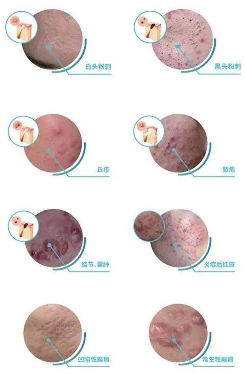 导致油脂不能顺利排出,造成毛孔堵塞,就形成我们所说的"白头粉刺"