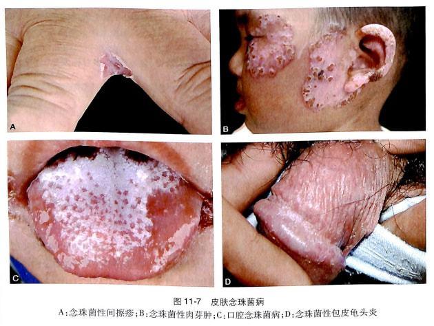 网易首页>正文申请入驻> ②慢性皮肤黏膜念珠菌病( chronie