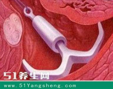 上环疼还是取环疼?看完才知道,女人一辈子就是疼过来的!