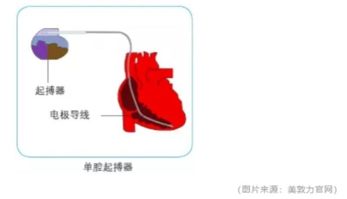 心脏备用"小马达"——心脏起搏器您了解吗?