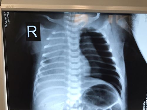 新生儿科成功抢救一例呼吸窘迫综合症并发大量气胸患儿