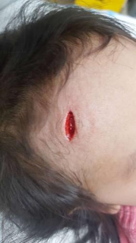 孩子头部磕流血了怎么办宝妈宝爸们一定要看原创