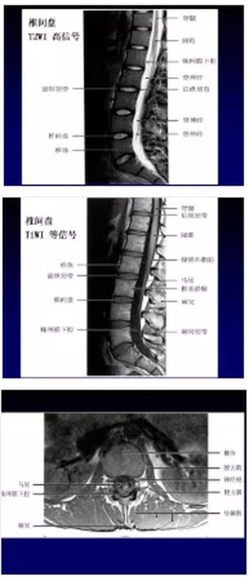 科普关于腰椎管狭窄症这篇文章讲得太全面了医术苑ube椎管狭窄ube脊柱
