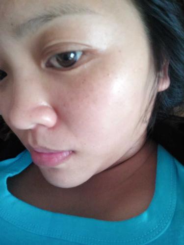 怀孕六个半月脸上斑越来越严重肿么办?