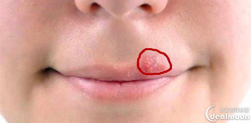 一招帮你快速摆脱口唇疱疹(cold sore)!