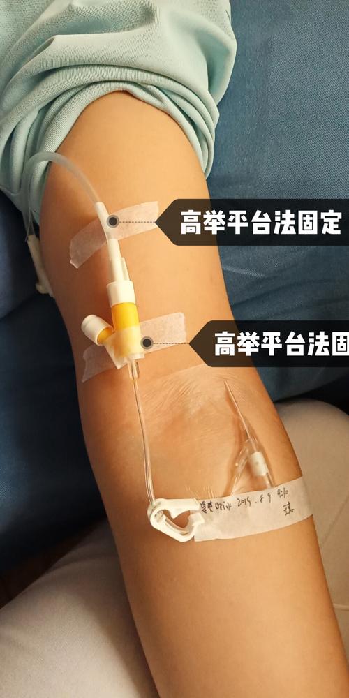 静脉留置针固定