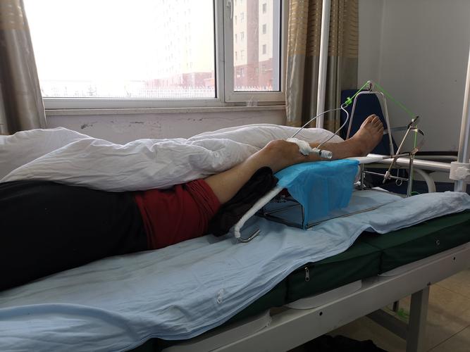 胫骨结节骨牵引术