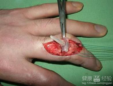 手背肌腱断裂术后能喝酒吗