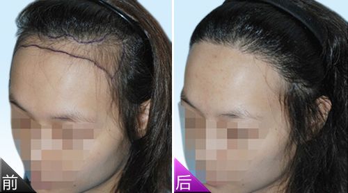 脱发际线项目前后对比图