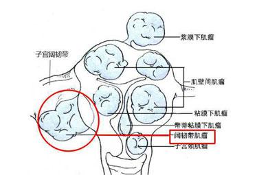 浆膜下肌瘤中突向阔韧带内的称为阔韧带肌瘤