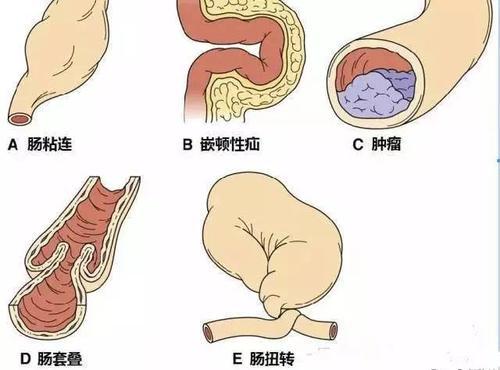 主要与对最初进行性结肠扩张所致的腹部膨胀和不适感耐受性较好有关