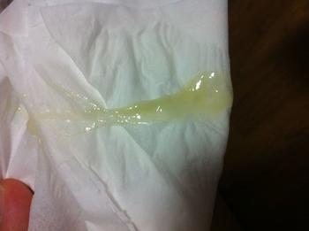 白带出现这5种异常状况,专家提醒,可能是宫颈癌,需