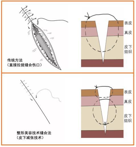 南京皮研所李崇照 的想法: 关于#减张精细缝合# 1,干