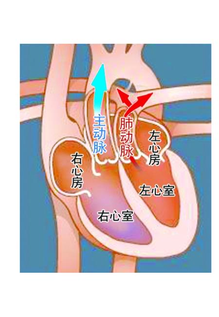病变心脏   完全性大动脉错位是指两根大动脉位置错换,主动脉接受