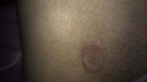 2013-11-16 10:26  最佳答案 湿疹,身体需要排湿气了.