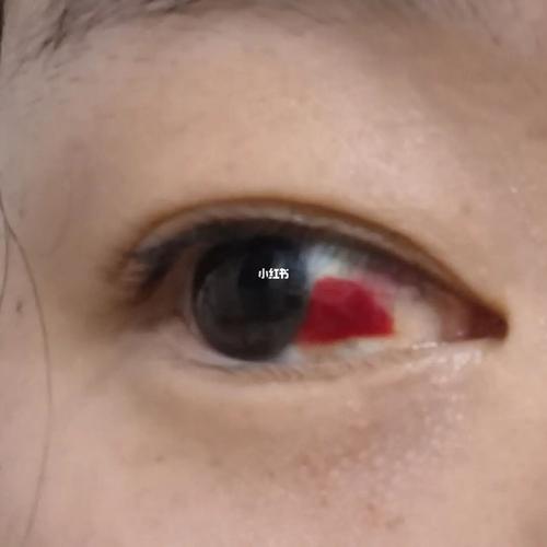 眼睛吐充血了是应该热敷还是冷敷啊?_眼睛_医疗健康