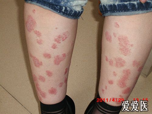 银屑病还是玫瑰糠疹