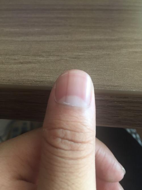 这种黑线是怎么回事指甲上