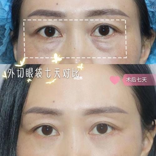 【外切眼袋】七天对比～_眼袋_去眼袋_紧致_外切眼袋