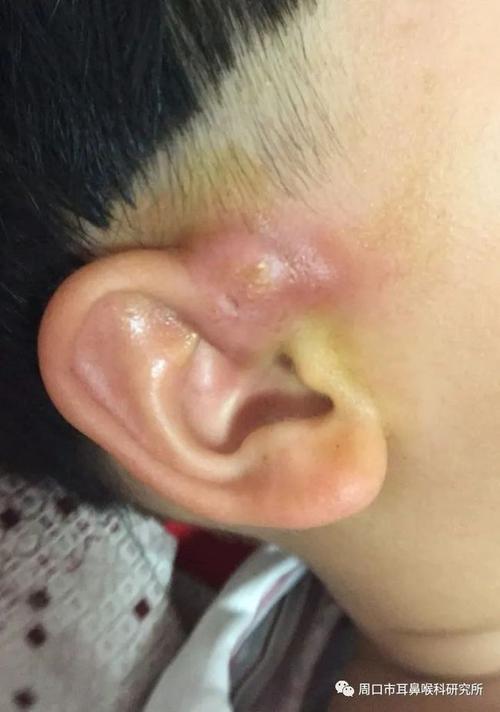 什么是先天性耳前瘘管