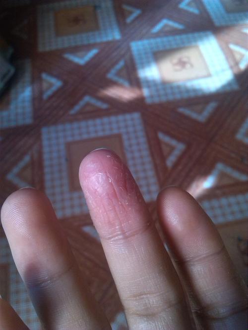 手指头开裂脱皮怎么回事?已经持续一个多月了,求高人解答下面上图.