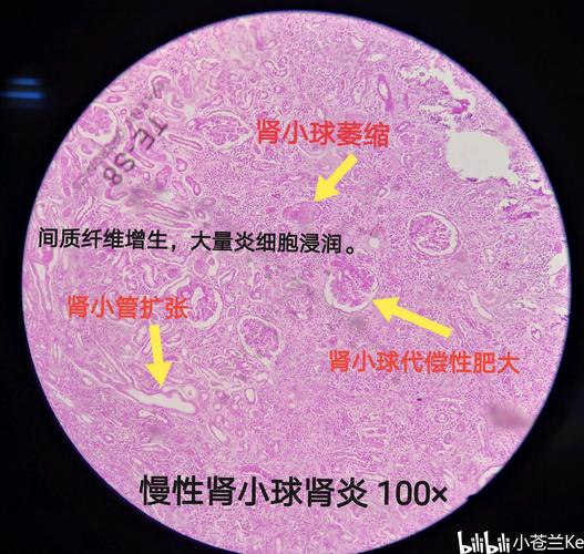慢性肾小球肾炎