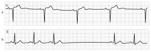 7 窦性心动过缓,窦性心律不齐及窦性停搏