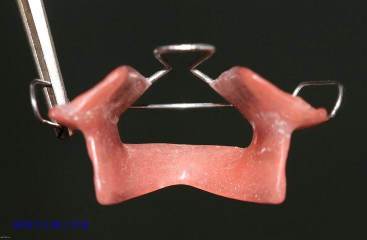 bionator矫治器的制作