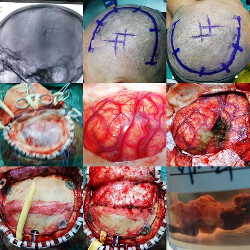 栓塞术毕立即送手术室开颅血肿清除 动静脉畸形切除术.