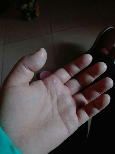 手被洗板水弄肿了