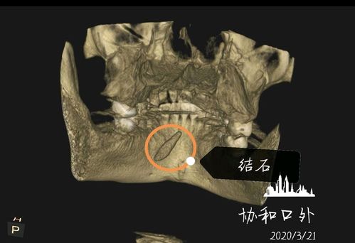 [科普]颌下腺导管结石