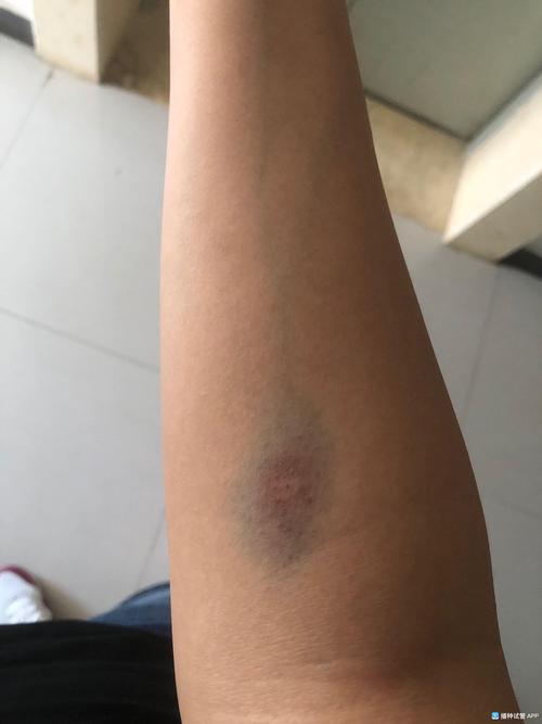 [试管婴儿]被一次次抽血抽得淤青的双手也在