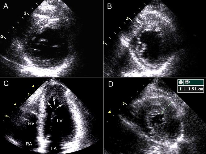 第2节 肥厚型心肌病