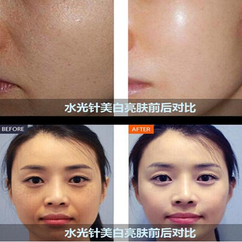 水光针效果对比