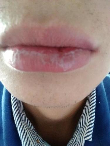 有医生知道我这嘴唇上是怎么了?不痒不痛,就是有白色