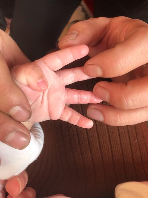 宝宝手上起的就跟小水泡是的  有知道是什么东西的吗