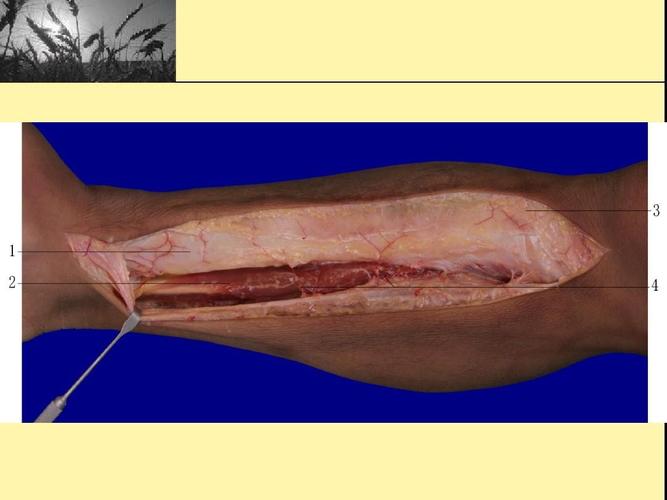 胫后动脉穿支皮瓣