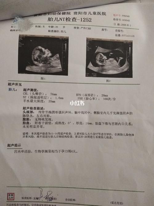 孕13周,nt秒过了,偏大4天._胎儿_胎盘_产科_儿童医院