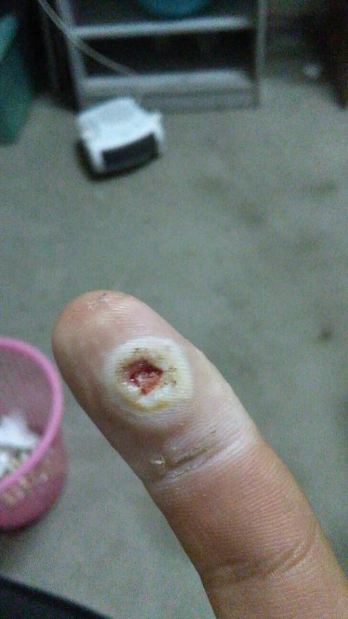 手上这个医生说是跖疣,两只脚上也有好几个,从肉里面长出来的,我用药